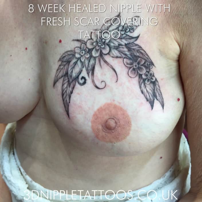 Fully Healed Nipple with Fresh Decorative Tattoo to Cover a Burn Scar